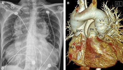 Successful surgical repair in an older adult with supracardiac total anomalous pulmonary venous connection: A case report